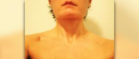 Chronic frozen shoulder
