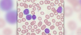 Chronic haemolytic anaemia