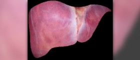 Chronic hepatitis C