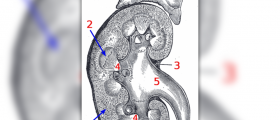 Chronic kidney disease