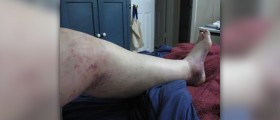 Chronic leg pain in children