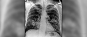 Chronic lung infection