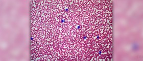 Chronic mononucleosis facts