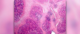 Chronic mrsa treatment