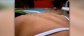Chronic pain treatment with acupuncture