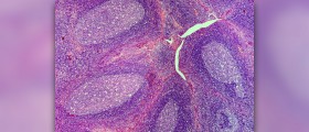 Chronic periodontitis facts