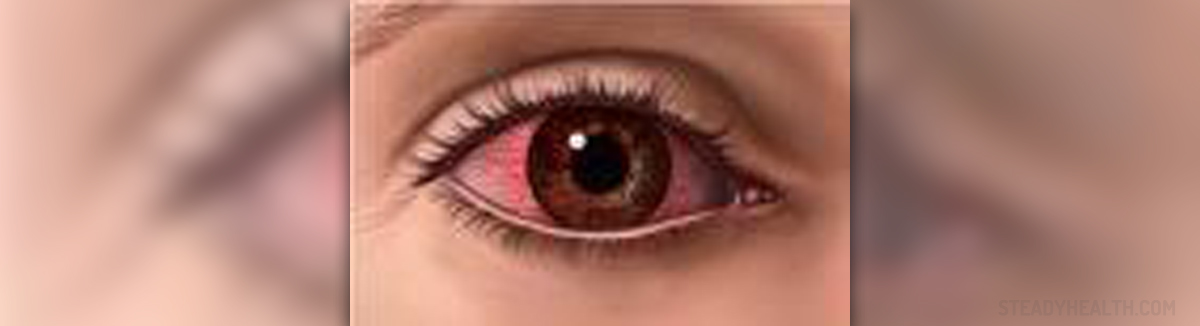 bloodshot eyes