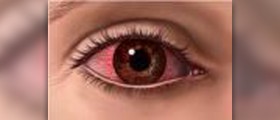 Chronic red eyes