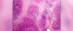 Chronic septic arthritis