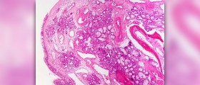 Chronic sinusitis facts