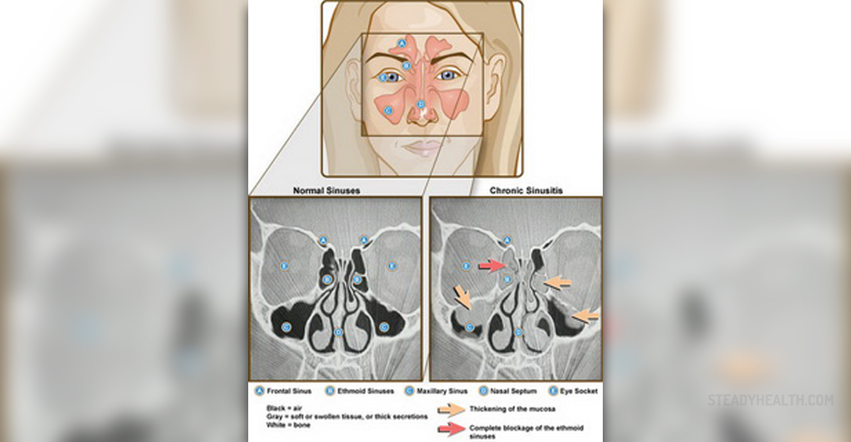 Prevention of sinusitis | Ear, Nose, Throat, and Dental problems ...