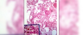 Chronic urinary retention