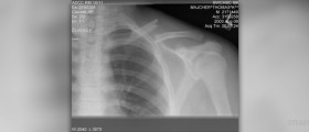 Clavicle fracture treatment