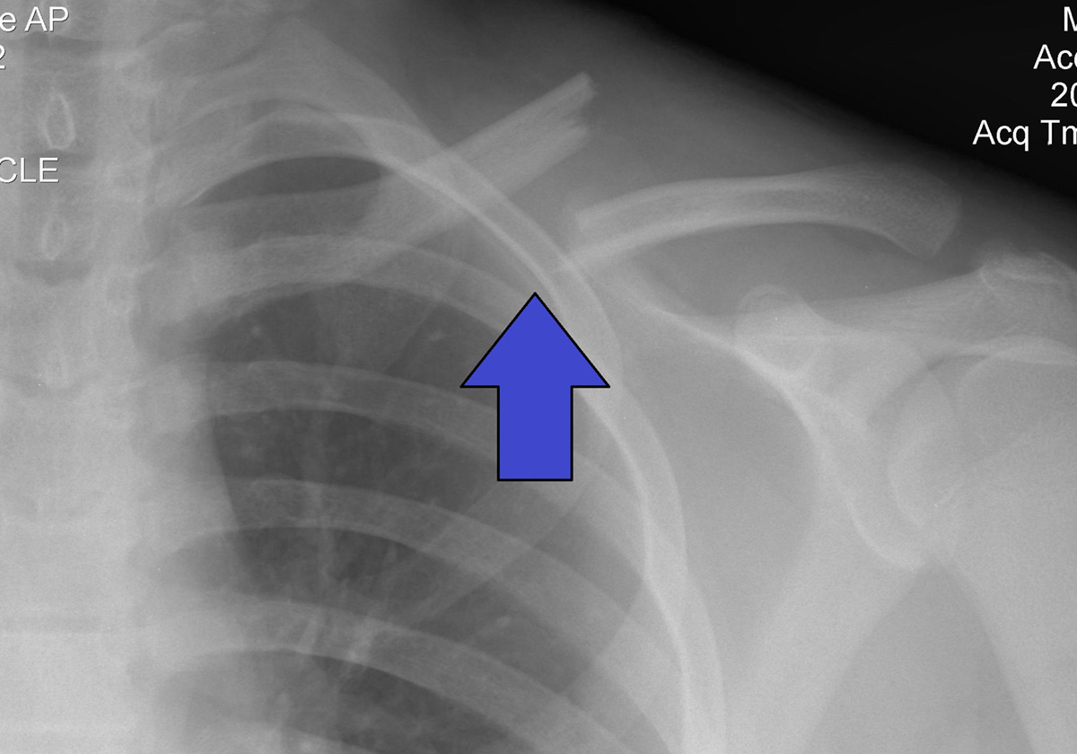 Clavicle pain facts | General center | SteadyHealth.com