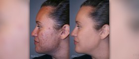 Clear skin fast with natural skin acne cure