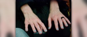 Cold hands and feet
