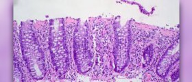 Collagenous colitis facts