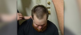 Combating male pattern baldness