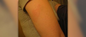 Common allergy symptoms and treatment options