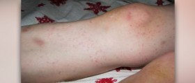 Common skin rashes