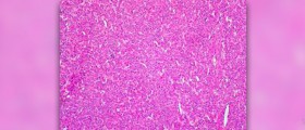 Complete hysterctomy information