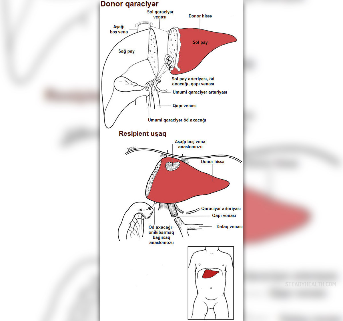 Complications after liver transplant General center