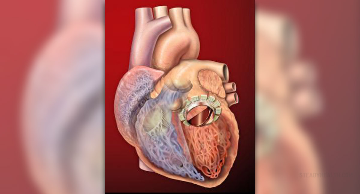 Complications after mitral valve replacement General