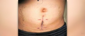 Complications of appendectomy