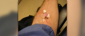 Complications of central venous catheterization