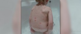 Complications of chickenpox
