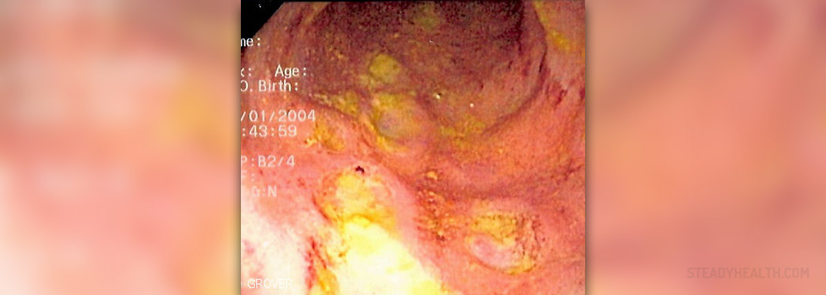 Complications of crohn s disease General center SteadyHealth.com