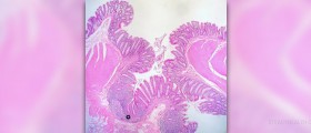 Complications of diverticulitis