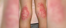 Complications of eczema