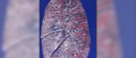 Complications of emphysema