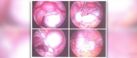 Complications of endometrial ablation