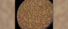 Complications of falciparum malaria