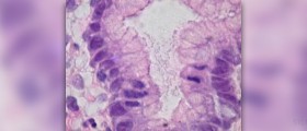 Complications of gastritis