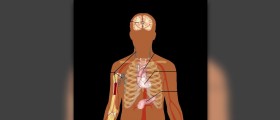 Complications of goiter