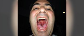 Complications of group A strep