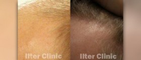 Complications of hair transplant