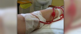 Complications of hemodialysis
