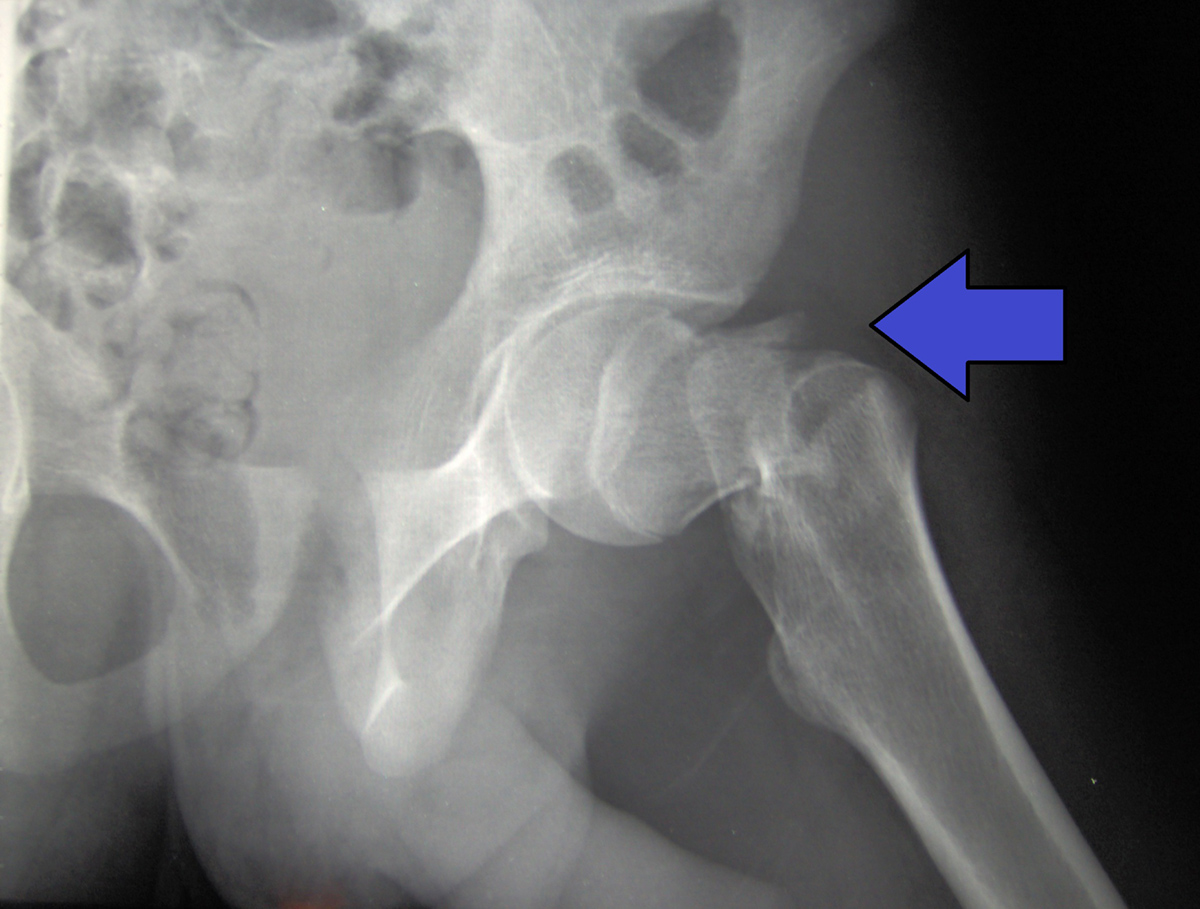 complications-of-hip-fracture-general-center-steadyhealth