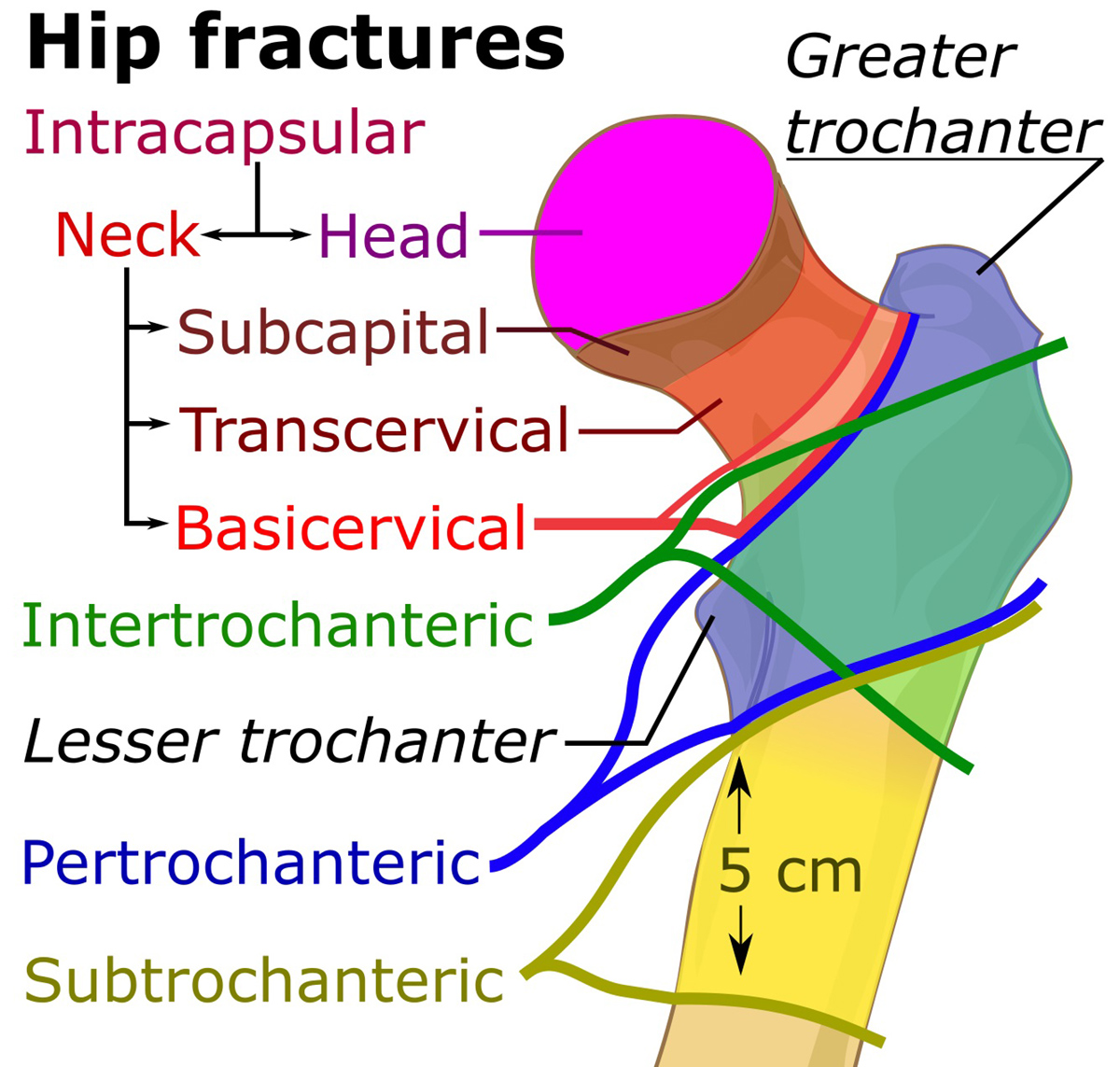 left intertrochanteric fracture icd 10