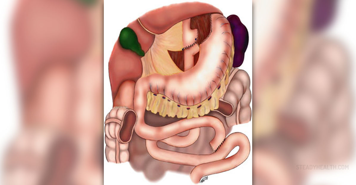 Is bariatric surgery dangerous