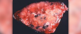 Complications of legionnaires disease