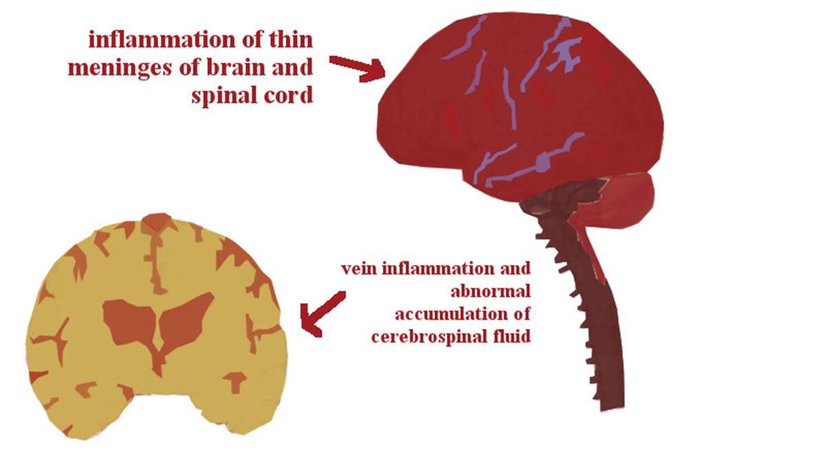 Complications of meningitis | General center | SteadyHealth.com