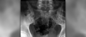 Complications of pelvic inflammatory disease