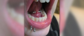 Complications of piercings