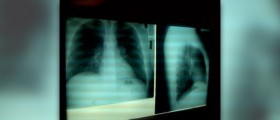 Complications of pneumonia in adults