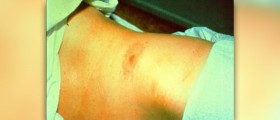 Complications of rocky mountain spotted fever